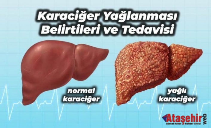 KARACİĞER YAĞLANMASINA KARŞI 3 SİLAHŞOR!