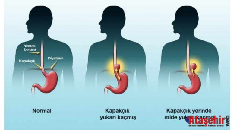 Reflü hastalığı son yıllarda yaygınlaşıyor!