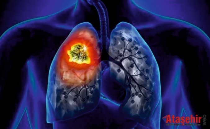 Akciğer kanserinde devrim yaratacak yeni tedavi yöntemi